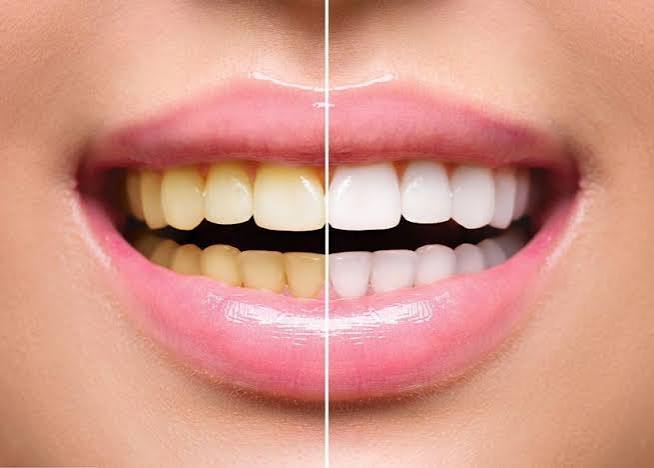 Teeth Whitening & Oral Care